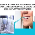 top 5 melhores irrigadores orais para implantes